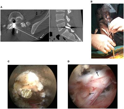 Case Report: Full-Endoscopic Surgery for Bullet Wounds of the Spine: A Report of Three Cases